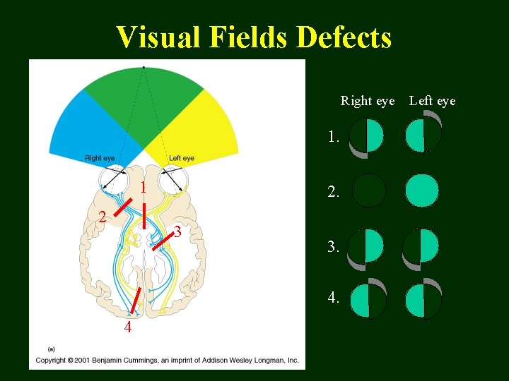 Visual Fields Defects Right eye 1. 1 2 2. 3 3. 4. 4 Left