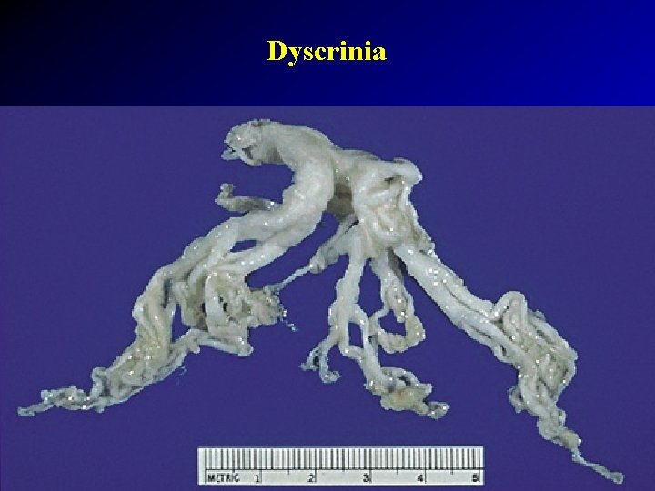 Dyscrinia 