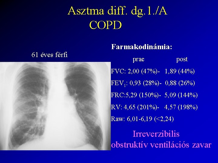 Asztma diff. dg. 1. /A COPD 61 éves férfi Farmakodinámia: prae post FVC: 2,