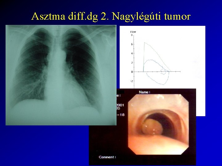 Asztma diff. dg 2. Nagylégúti tumor 