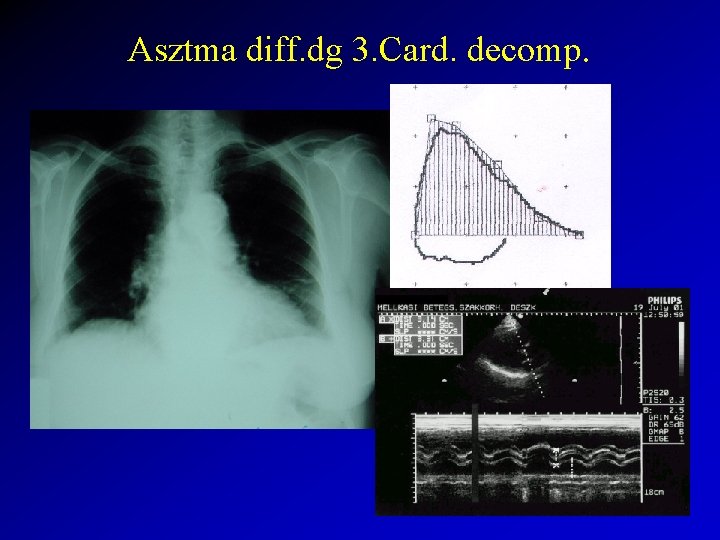 Asztma diff. dg 3. Card. decomp. 
