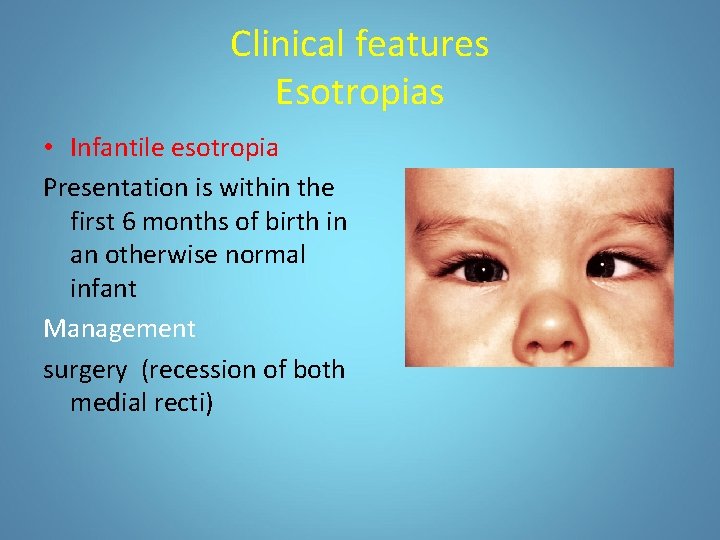 Clinical features Esotropias • Infantile esotropia Presentation is within the first 6 months of