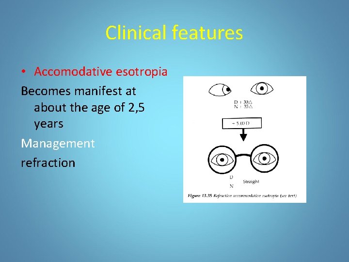 Clinical features • Accomodative esotropia Becomes manifest at about the age of 2, 5