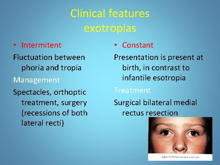 Clinical features exotropias • Intermitent Fluctuation between phoria and tropia Management Spectacles, orthoptic treatment,