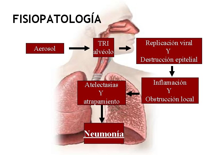 FISIOPATOLOGÍA Aerosol TRI alvéolo Replicación viral Y Destrucción epitelial Atelectasias Y atrapamiento Inflamación Y