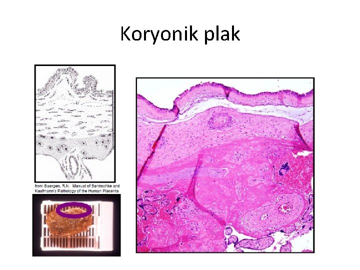 Koryonik plak 