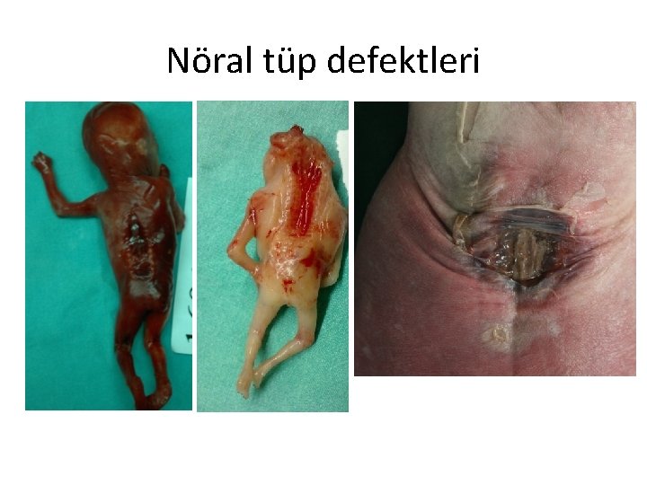 Nöral tüp defektleri 