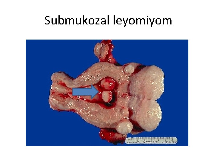 Submukozal leyomiyom 