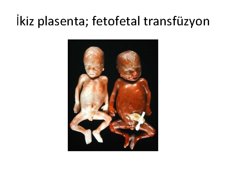 İkiz plasenta; fetofetal transfüzyon 