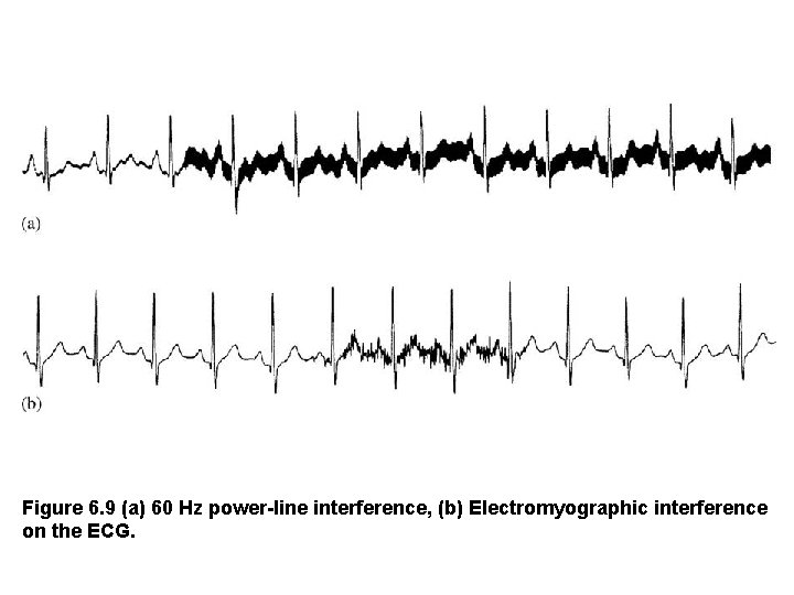 Figure 6. 9 (a) 60 Hz power-line interference, (b) Electromyographic interference on the ECG.