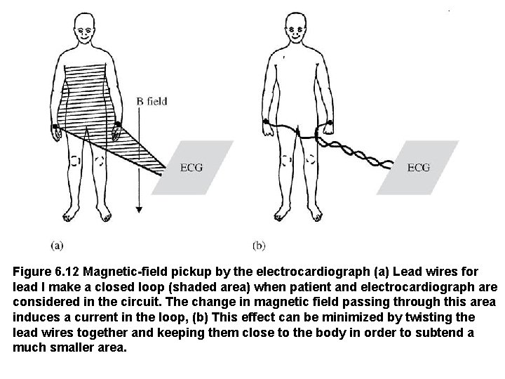 Figure 6. 12 Magnetic-field pickup by the electrocardiograph (a) Lead wires for lead I