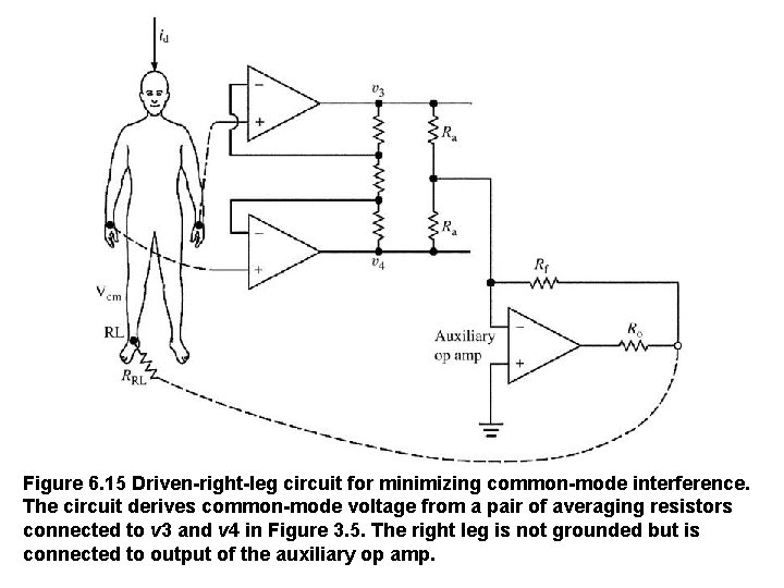 Figure 6. 15 Driven-right-leg circuit for minimizing common-mode interference. The circuit derives common-mode voltage
