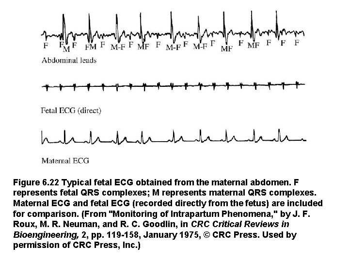 Figure 6. 22 Typical fetal ECG obtained from the maternal abdomen. F represents fetal