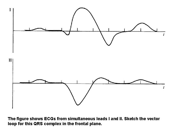 The figure shows ECGs from simultaneous leads I and II. Sketch the vector loop