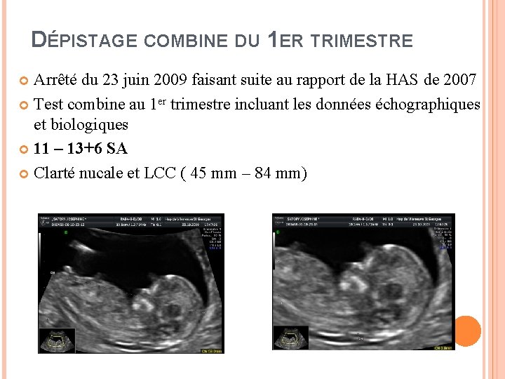 DÉPISTAGE COMBINE DU 1 ER TRIMESTRE Arrêté du 23 juin 2009 faisant suite au