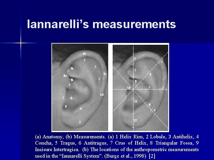 Iannarelli’s measurements (a) Anatomy, (b) Measurements. (a) 1 Helix Rim, 2 Lobule, 3 Antihelix,