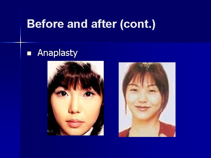 Before and after (cont. ) n Anaplasty 