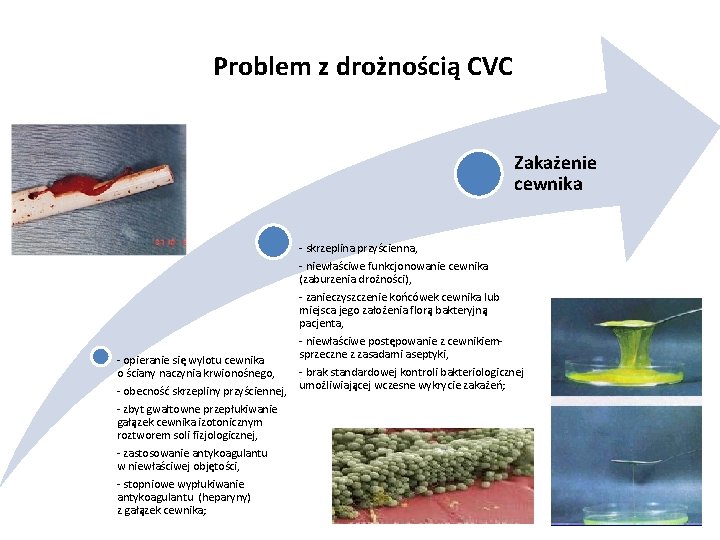 Problem z drożnością CVC Zakażenie cewnika - skrzeplina przyścienna, - niewłaściwe funkcjonowanie cewnika (zaburzenia