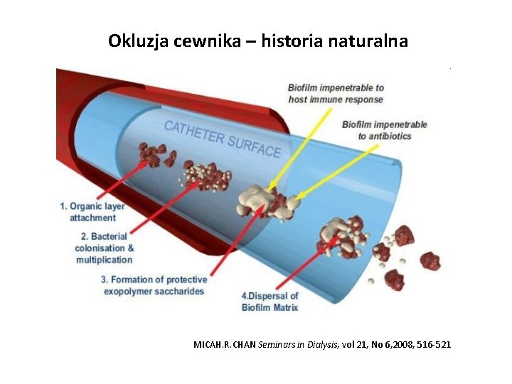 Okluzja cewnika – historia naturalna MICAH. R. CHAN Seminars in Dialysis, vol 21, No