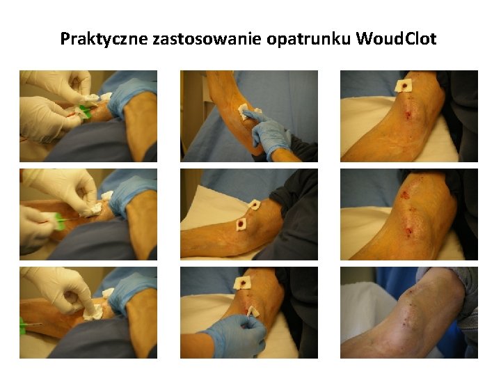 Praktyczne zastosowanie opatrunku Woud. Clot 