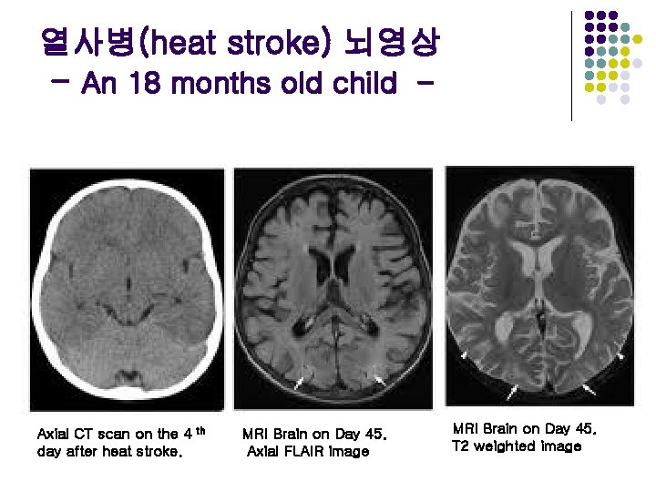 열사병(heat stroke) 뇌영상 - An 18 months old child - Axial CT scan on