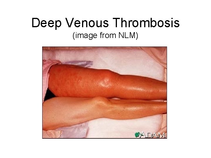 Deep Venous Thrombosis (image from NLM) 