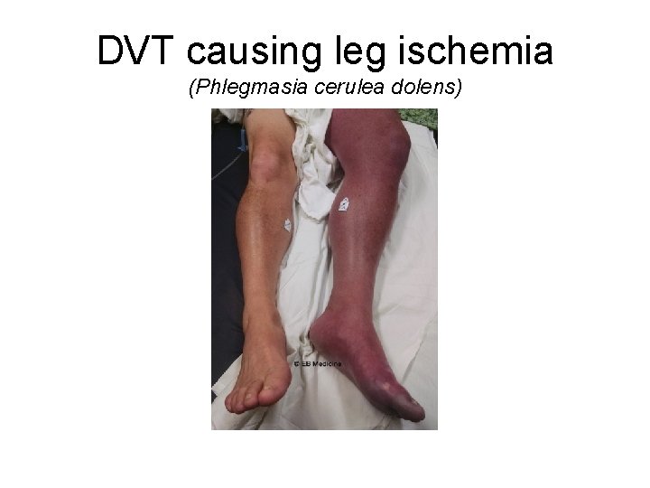DVT causing leg ischemia (Phlegmasia cerulea dolens) 