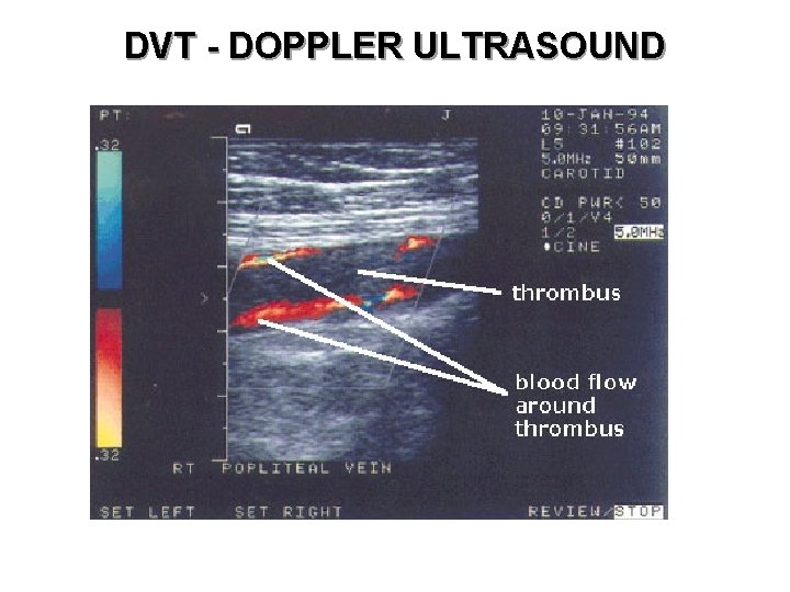 DVT - DOPPLER ULTRASOUND 