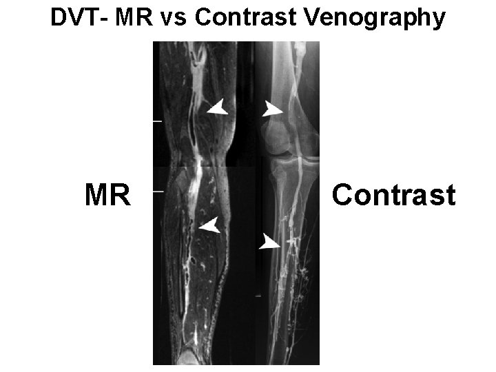 DVT- MR vs Contrast Venography MR Contrast 