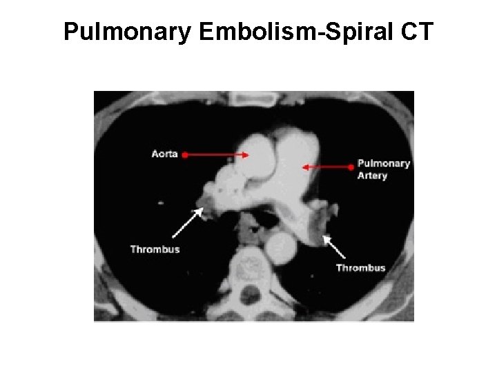 Pulmonary Embolism-Spiral CT 