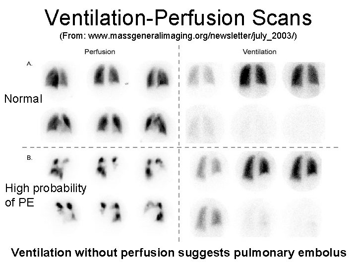 Ventilation-Perfusion Scans (From: www. massgeneralimaging. org/newsletter/july_2003/) Normal High probability of PE Ventilation without perfusion
