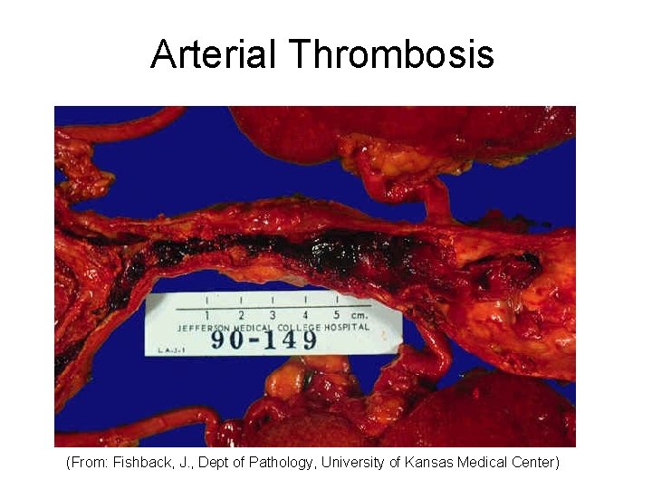 Arterial Thrombosis (From: Fishback, J. , Dept of Pathology, University of Kansas Medical Center)