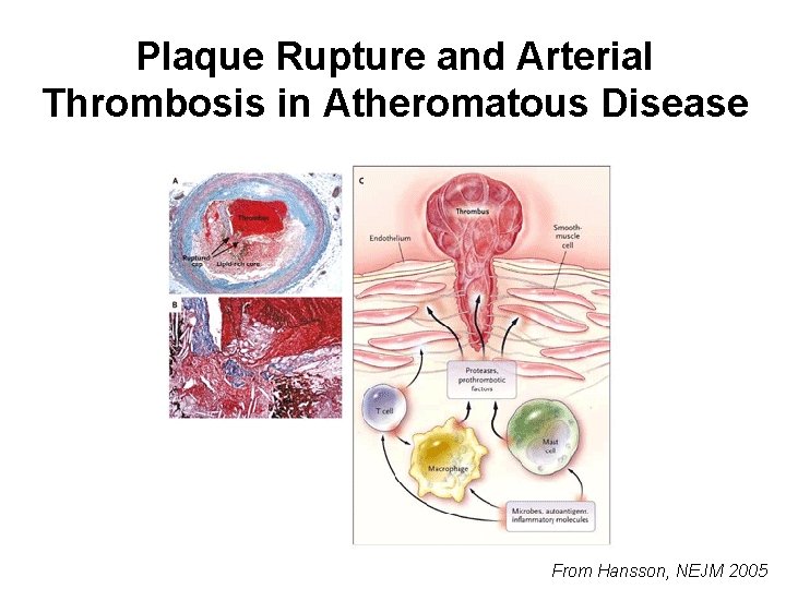 Plaque Rupture and Arterial Thrombosis in Atheromatous Disease From Hansson, NEJM 2005 
