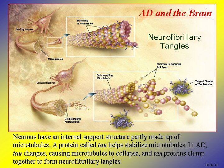 AD and the Brain Neurofibrillary Tangles Neurons have an internal support structure partly made