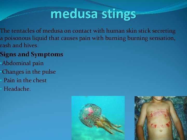 medusa stings The tentacles of medusa on contact with human skin stick secreting a