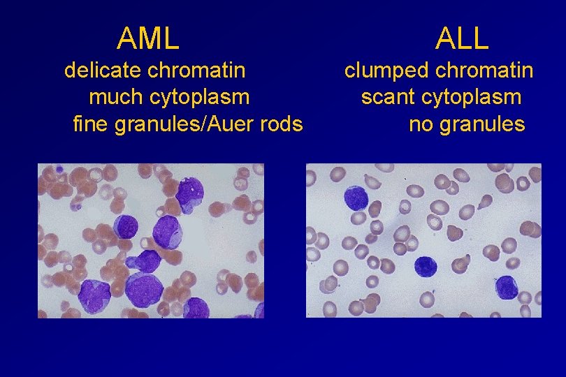  AML ALL delicate chromatin clumped chromatin much cytoplasm scant cytoplasm fine granules/Auer rods