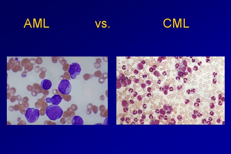 AML vs. CML 