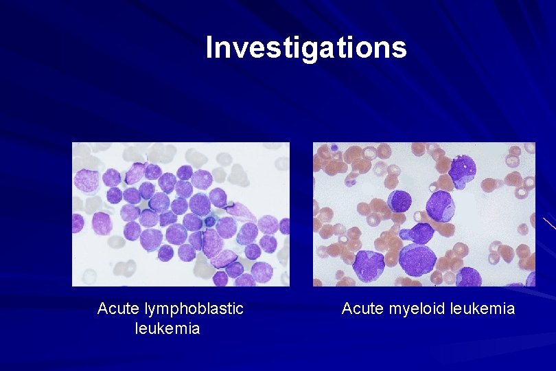 Investigations Acute lymphoblastic leukemia Acute myeloid leukemia 