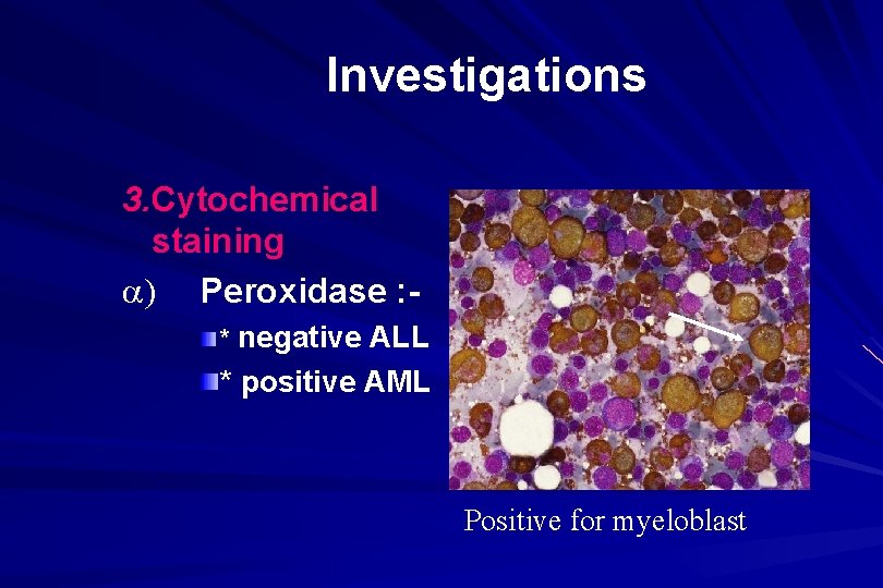 Investigations 3. Cytochemical staining ) Peroxidase : * negative ALL * positive AML Positive