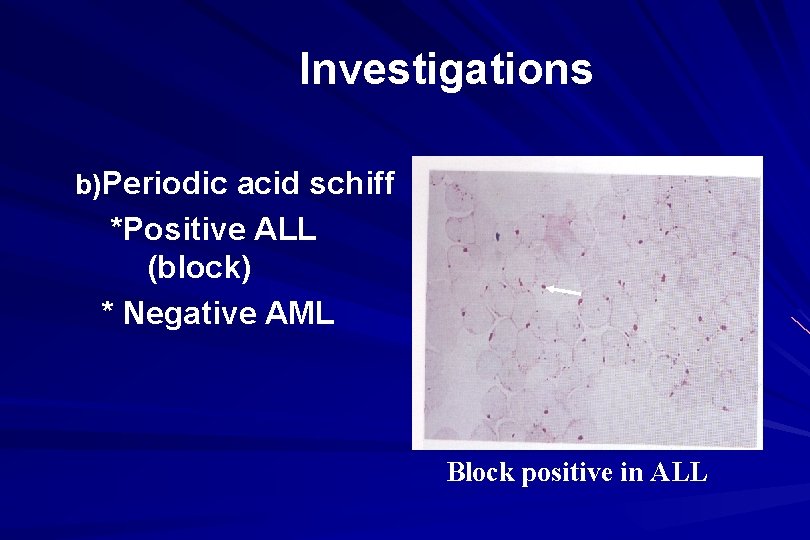 Investigations b)Periodic acid schiff *Positive ALL (block) * Negative AML Block positive in ALL