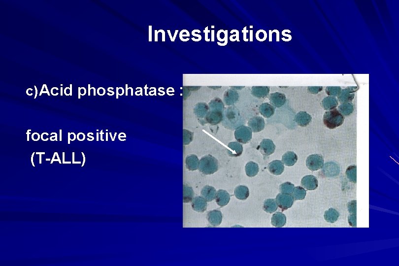 Investigations c) Acid phosphatase : focal positive (T-ALL) 