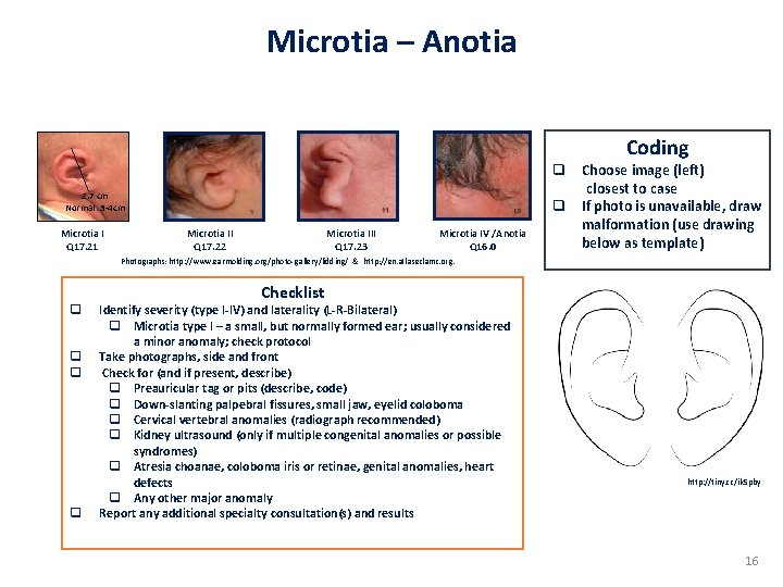 Microtia – Anotia Coding 2. 7 cm Normal: 3 -4 cm Microtia I Q