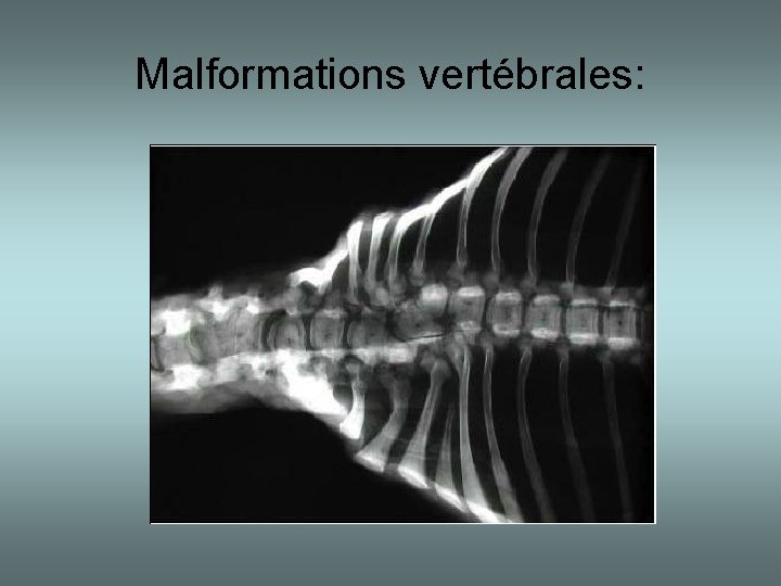 Malformations vertébrales: 