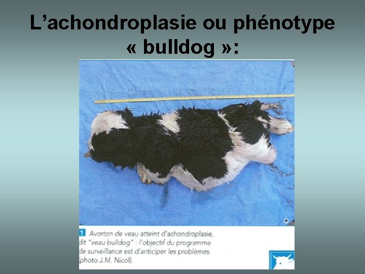 L’achondroplasie ou phénotype « bulldog » : 