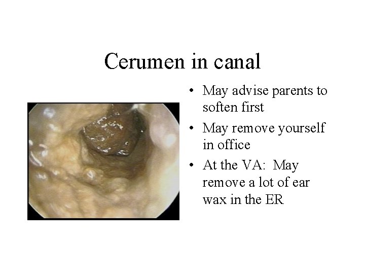 Cerumen in canal • May advise parents to soften first • May remove yourself