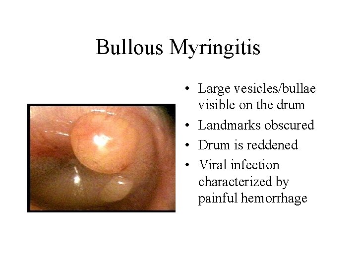 Bullous Myringitis • Large vesicles/bullae visible on the drum • Landmarks obscured • Drum