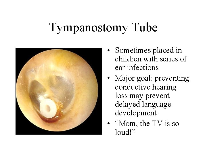 Tympanostomy Tube • Sometimes placed in children with series of ear infections • Major