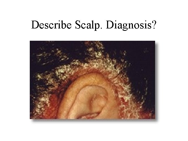 Describe Scalp. Diagnosis? 