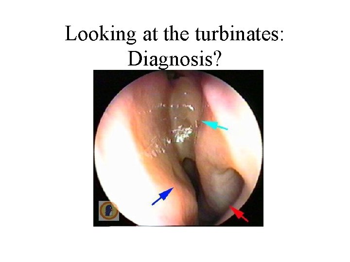 Looking at the turbinates: Diagnosis? 