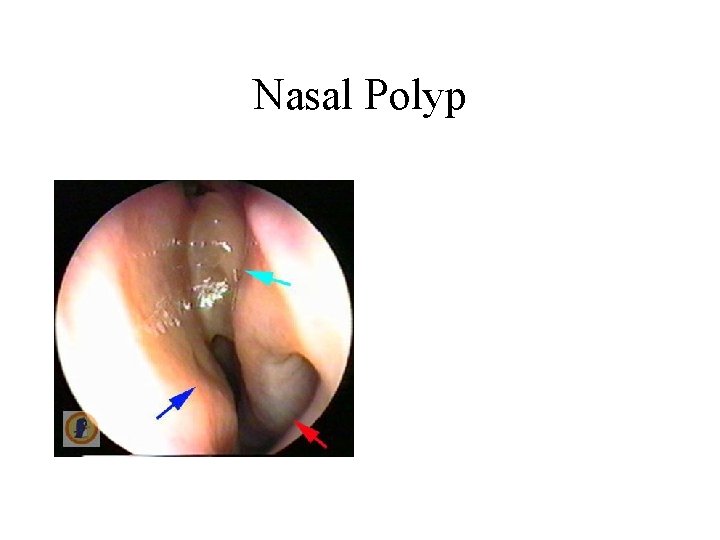 Nasal Polyp 